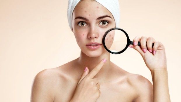 هر آنچه که می خواهید در مورد آکنه بدانید